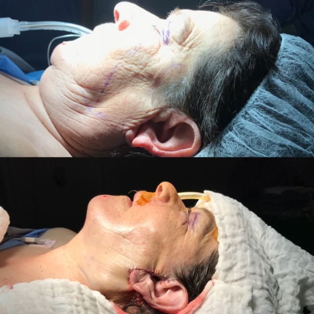 Lifting Facial - Dr. Gustavo Bravo